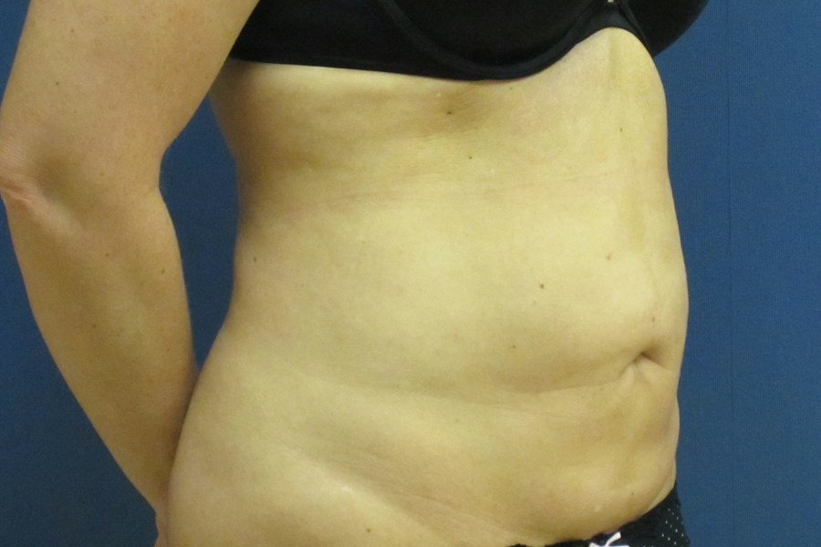 Patient 13664 | Angle View | Before — Dr. Tommaso Addona -