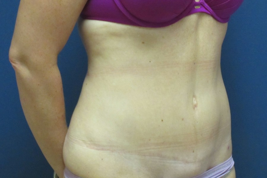 Patient 13664 | Angle View | After — Dr. Tommaso Addona -