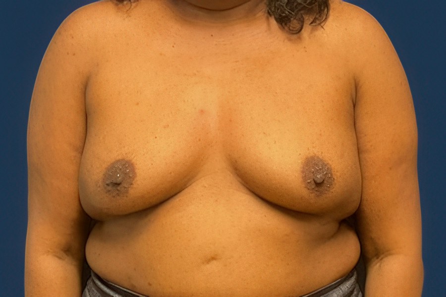 Patient 50687 | Front View | Before — Dr. Tommaso Addona -