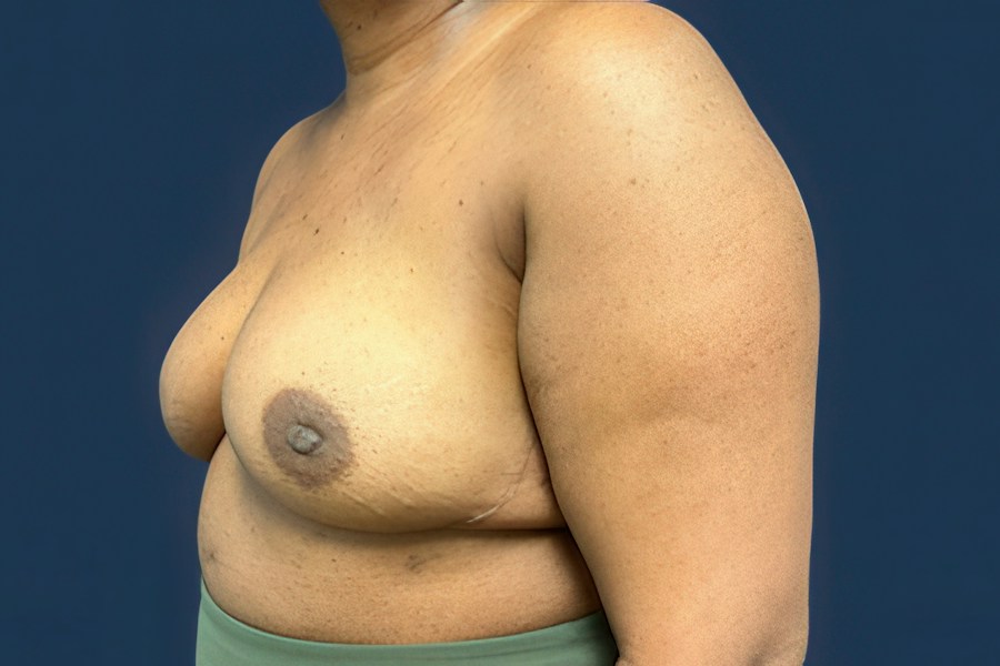 Patient 50687 | Angle View | After — Dr. Tommaso Addona -
