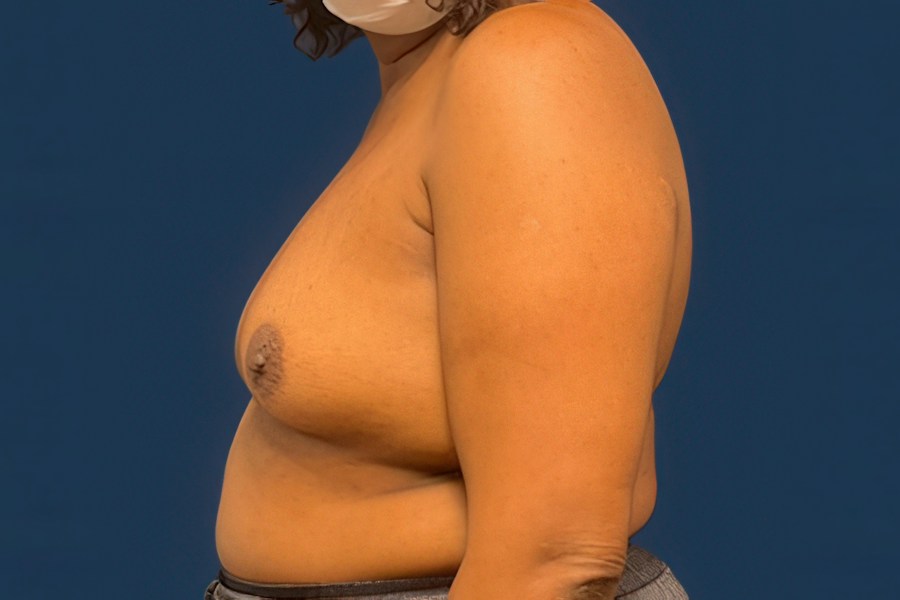 Patient 50687 | Profile View | Before — Dr. Tommaso Addona -