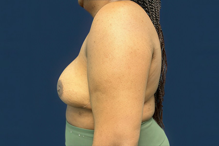 Patient 50687 | Profile View | After — Dr. Tommaso Addona -