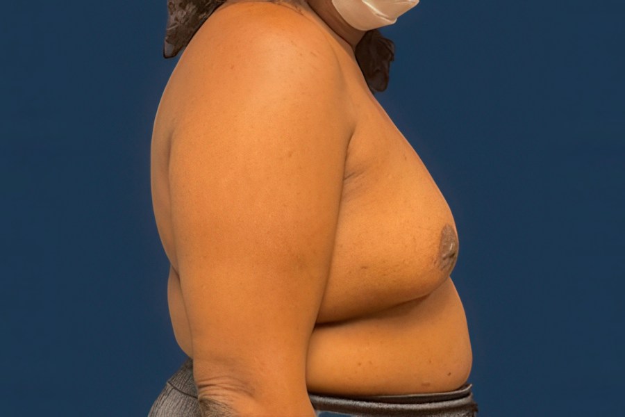 Patient 50687 | Profile View | Before — Dr. Tommaso Addona -