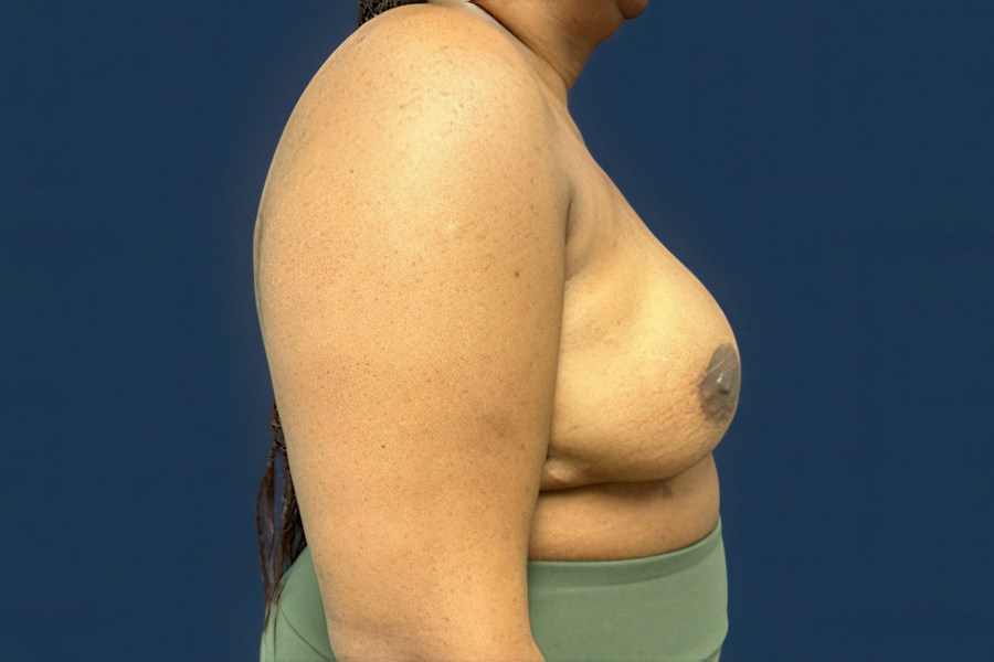 Patient 50687 | Profile View | After — Dr. Tommaso Addona -