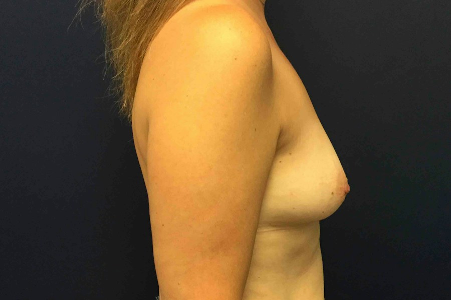 Patient 23815 | Profile View | Before — Dr. Tommaso Addona -