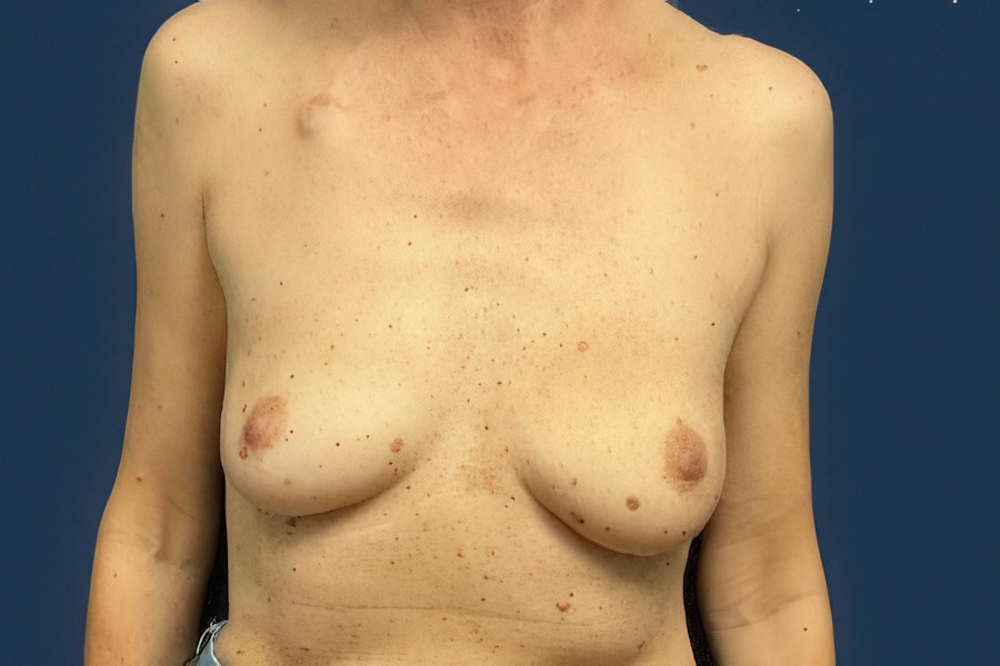 Patient 65128 | Front View | Before — Dr. Tommaso Addona -