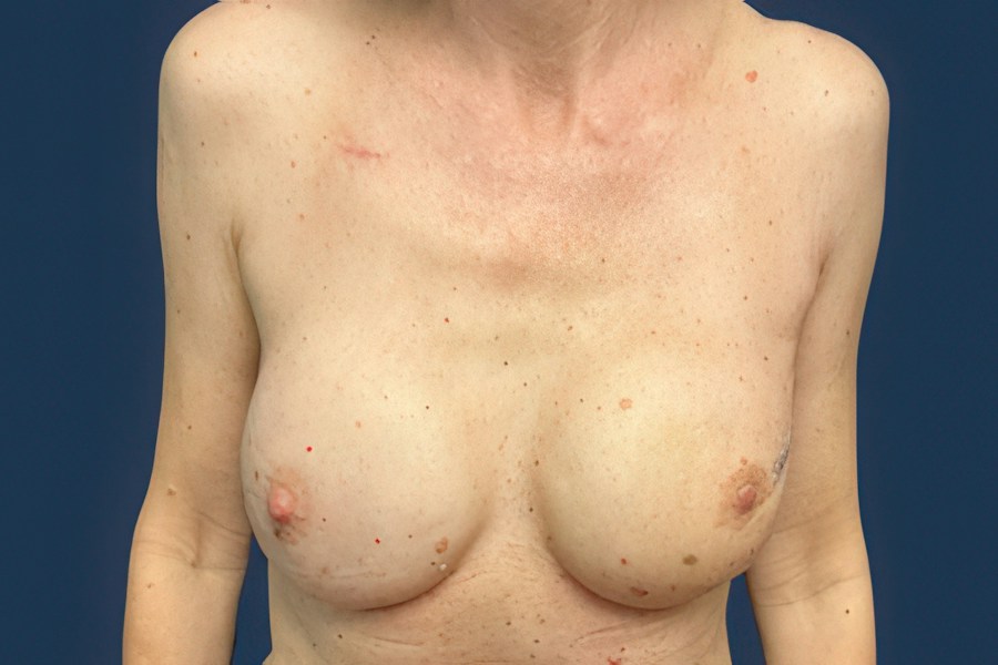 Patient 65128 | Front View | After — Dr. Tommaso Addona -