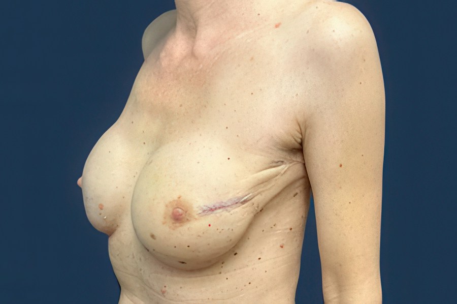 Patient 65128 | Angle View | After — Dr. Tommaso Addona -