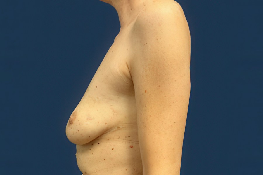 Patient 65128 | Profile View | Before — Dr. Tommaso Addona -