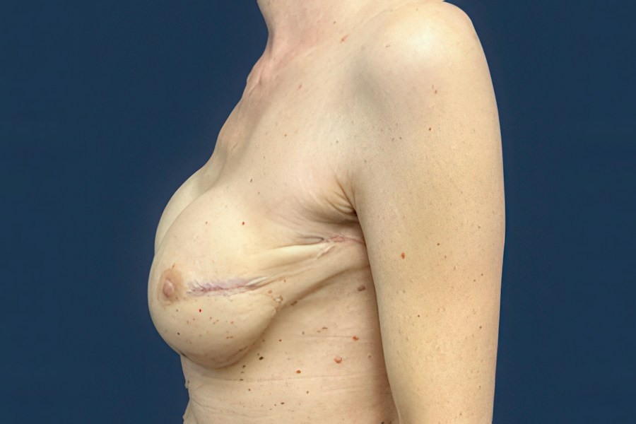 Patient 65128 | Profile View | After — Dr. Tommaso Addona -