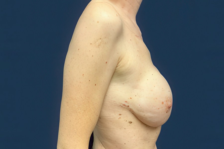 Patient 65128 | Profile View | After — Dr. Tommaso Addona -