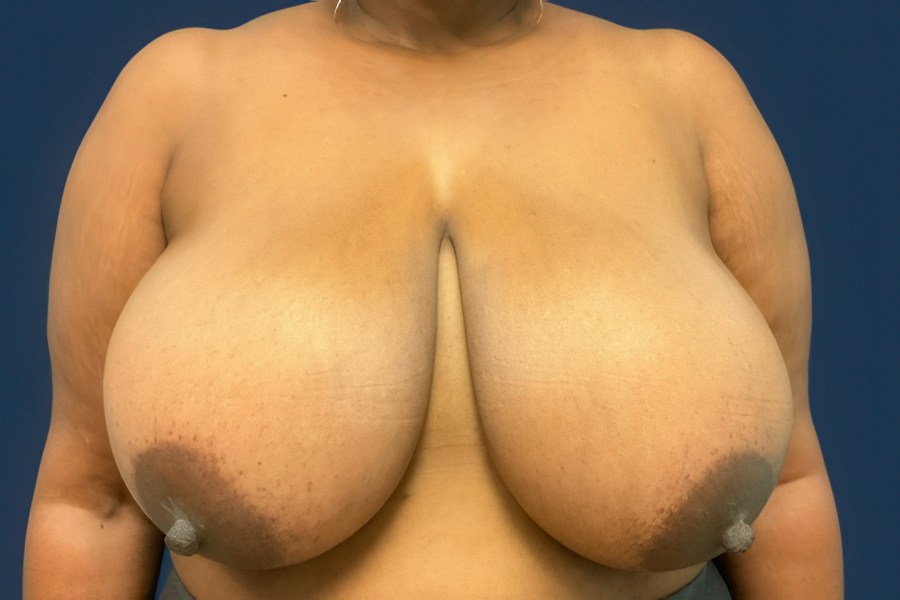 Patient 80634 | Front View | Before — Dr. Tommaso Addona -