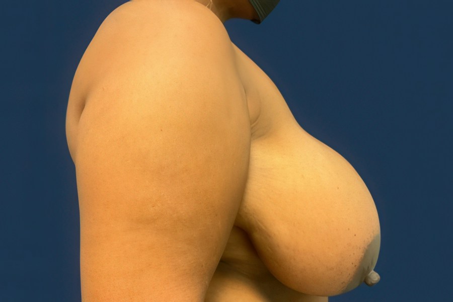 Patient 80634 | Profile View | Before — Dr. Tommaso Addona -