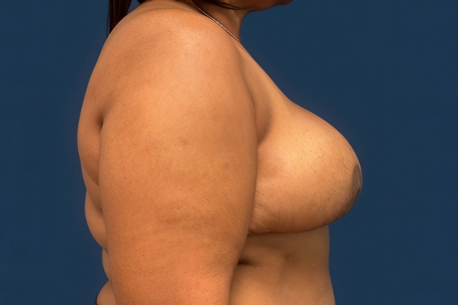 Patient 80634 | Profile View | After — Dr. Tommaso Addona -