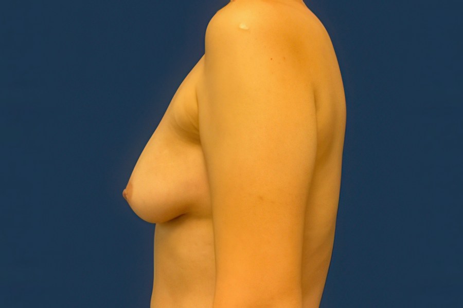 Patient 63244 | Profile View | Before — Dr. Tommaso Addona -