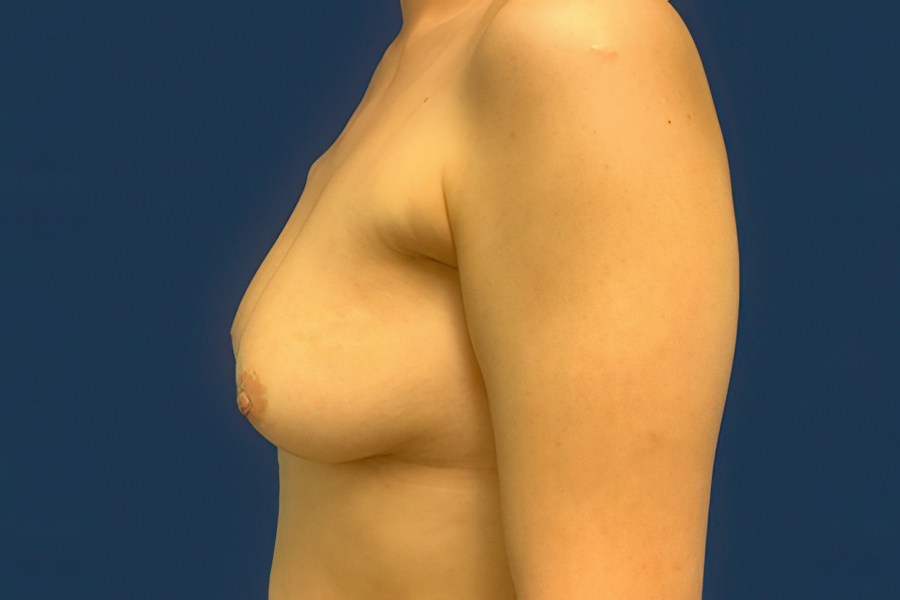 Patient 63244 | Profile View | After — Dr. Tommaso Addona -