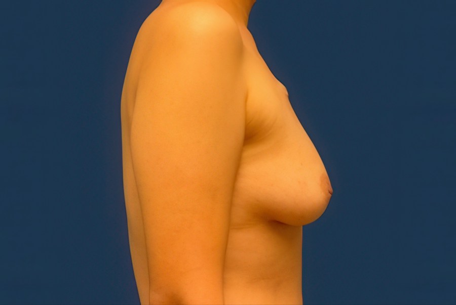 Patient 63244 | Profile View | Before — Dr. Tommaso Addona -