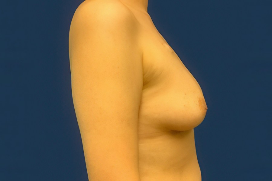 Patient 63244 | Profile View | After — Dr. Tommaso Addona -