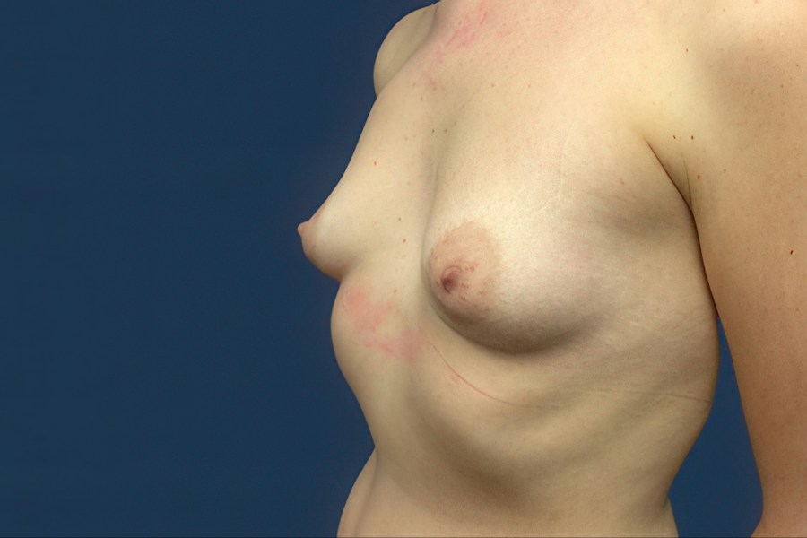 Patient 26965 | Angle View | Before — Dr. Tommaso Addona -