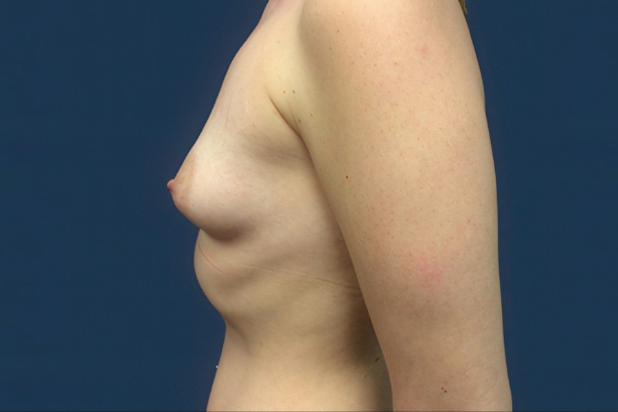 Patient 26965 | Profile View | Before — Dr. Tommaso Addona -
