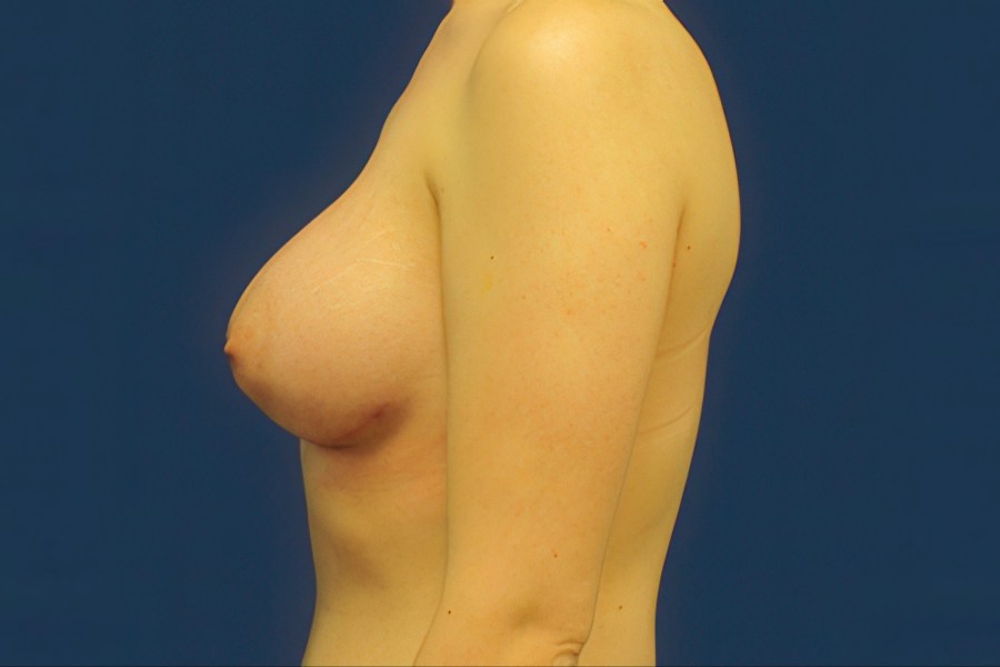 Patient 26965 | Profile View | After — Dr. Tommaso Addona -