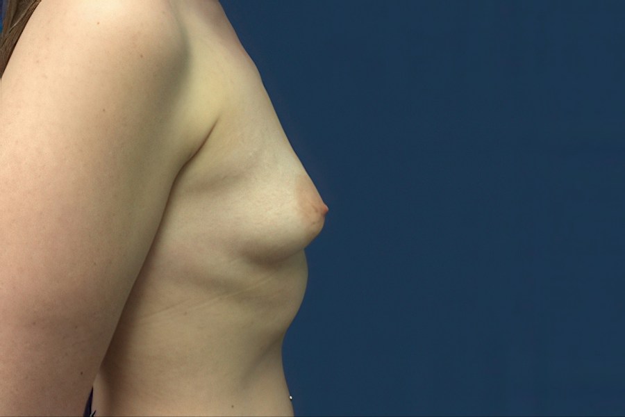 Patient 26965 | Profile View | Before — Dr. Tommaso Addona -