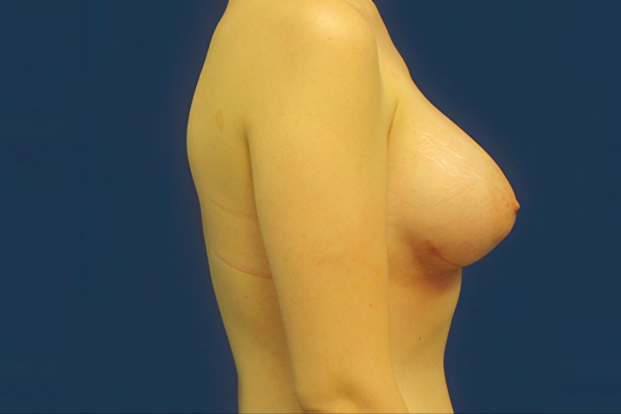 Patient 26965 | Profile View | After — Dr. Tommaso Addona -