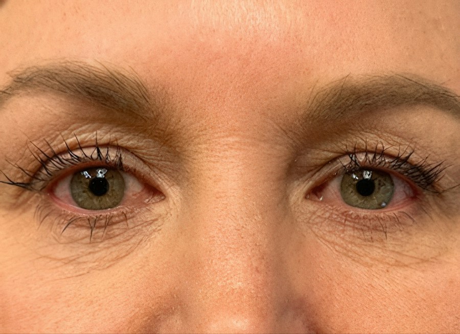 Patient 61261 | Front View | Before — Dr. Tommaso Addona -