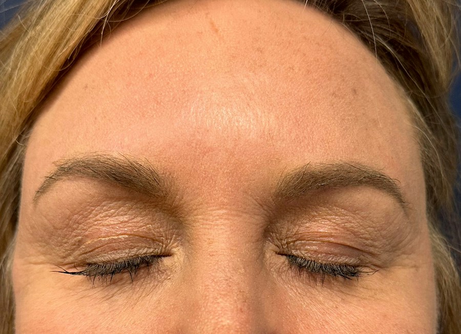 Patient 61261 | Front View | Before — Dr. Tommaso Addona -