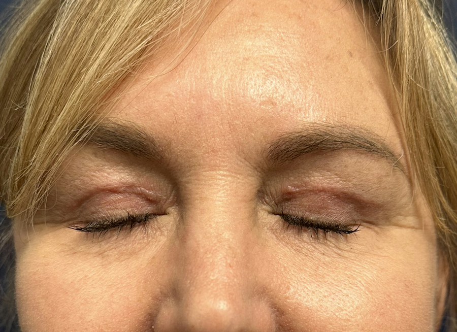 Patient 61261 | Front View | After — Dr. Tommaso Addona -