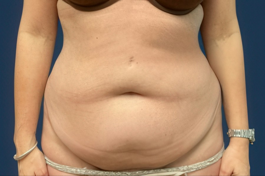 Patient 80353 | Front View | Before — Dr. Tommaso Addona -
