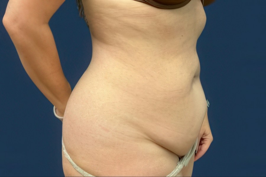 Patient 80353 | Angle View | Before — Dr. Tommaso Addona -