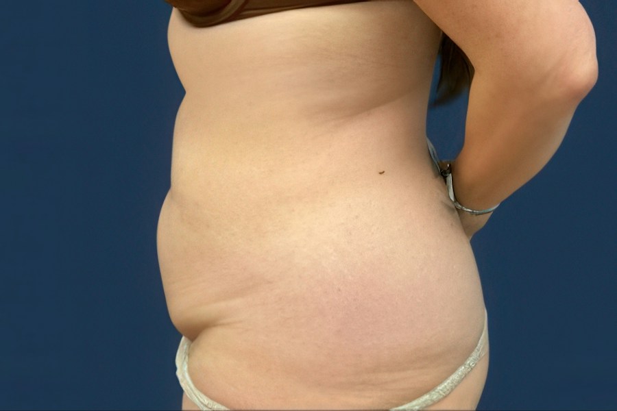 Patient 80353 | Profile View | Before — Dr. Tommaso Addona -