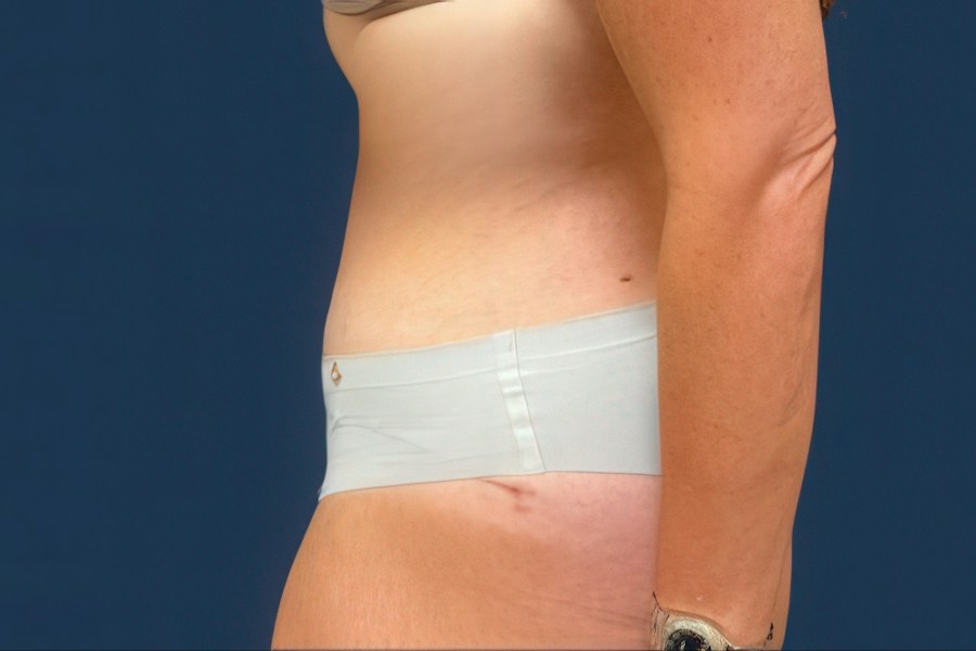 Patient 80353 | Profile View | After — Dr. Tommaso Addona -