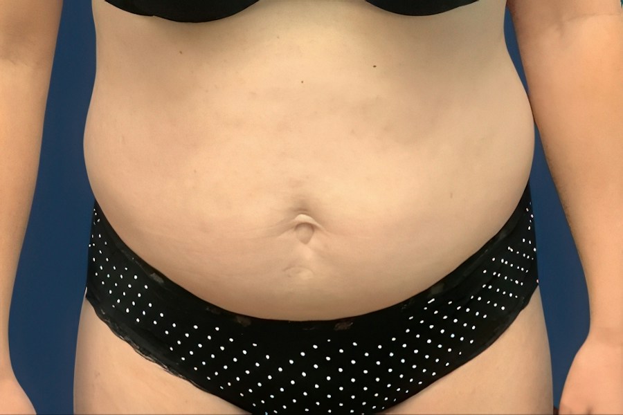 Patient 80685 | Front View | Before — Dr. Tommaso Addona -