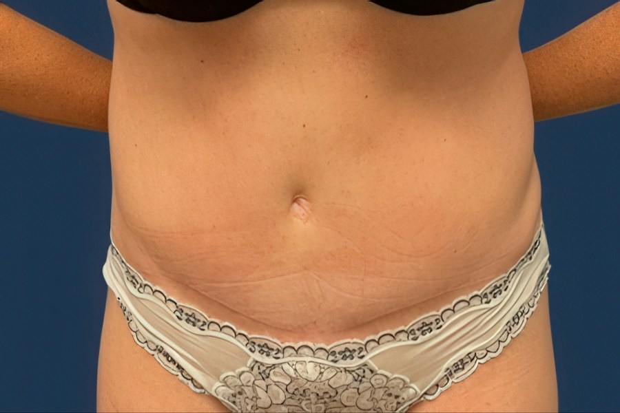 Patient 80685 | Front View | After — Dr. Tommaso Addona -
