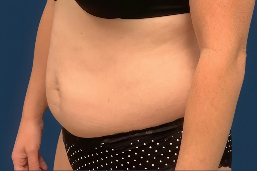 Patient 80685 | Angle View | Before — Dr. Tommaso Addona -