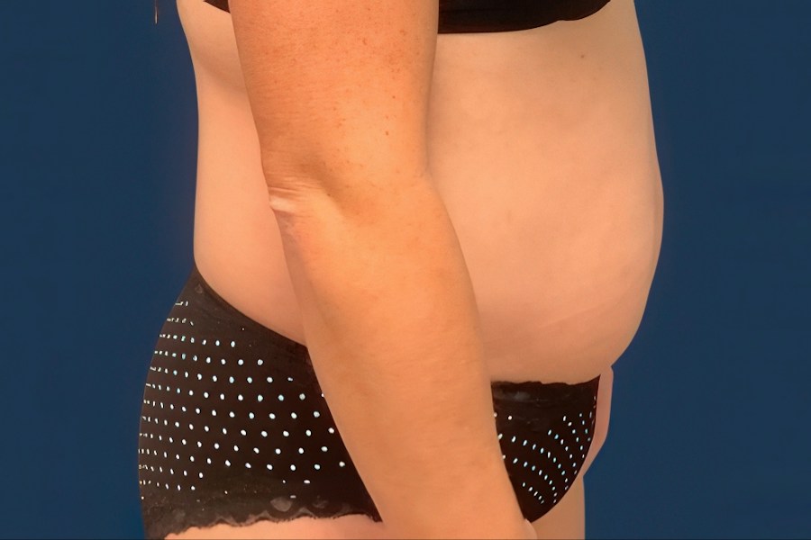 Patient 80685 | Profile View | Before — Dr. Tommaso Addona -