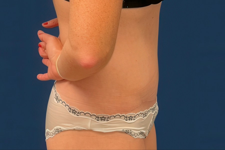 Patient 80685 | Profile View | After — Dr. Tommaso Addona -