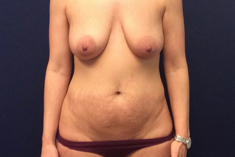 Patient 80354 | Front View | Before — Dr. Tommaso Addona -