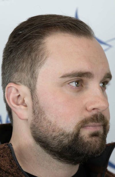 Results Before & After Gallery - Patient 423185 - Image 1