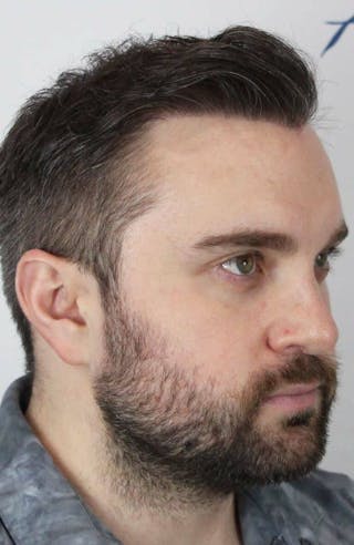 Results Before & After Gallery - Patient 423185 - Image 2