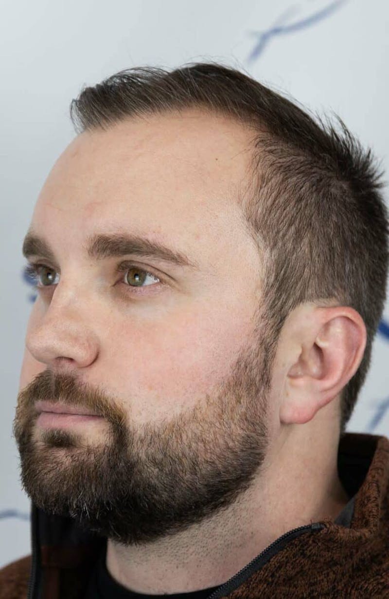 Results Before & After Gallery - Patient 423185 - Image 3