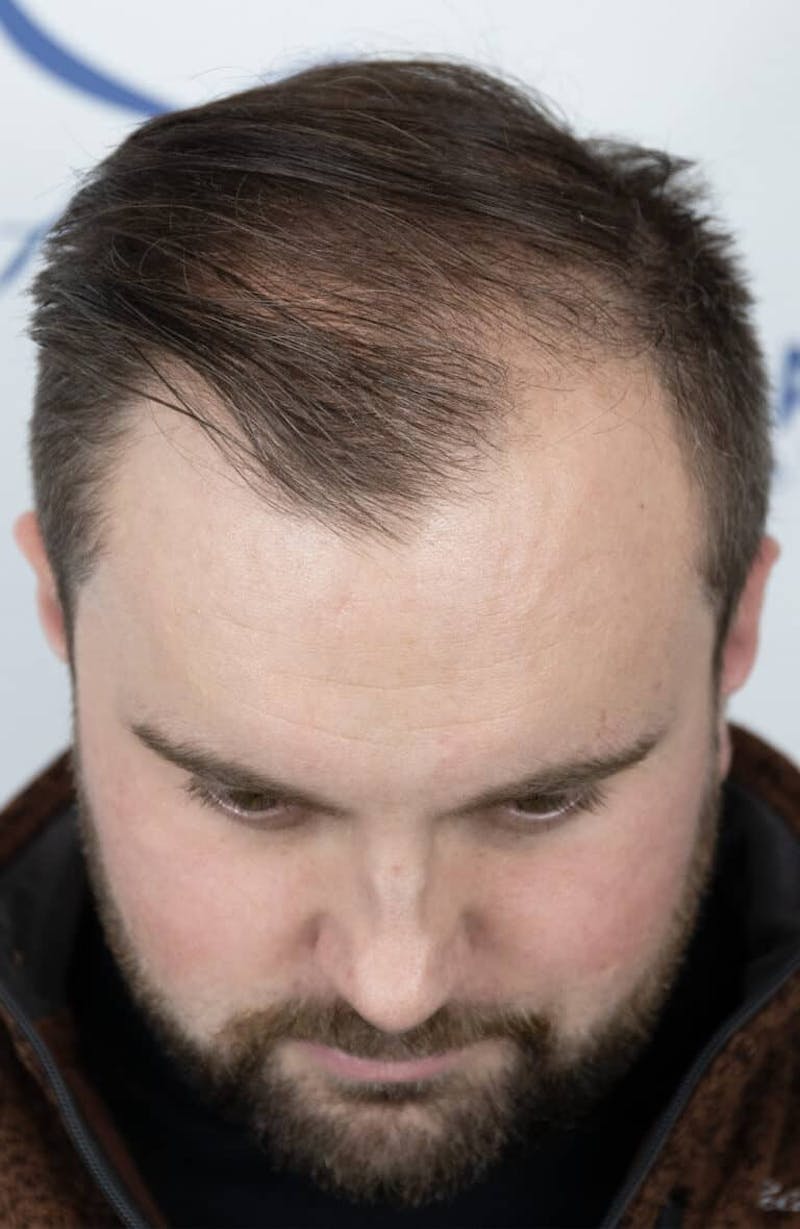 Results Before & After Gallery - Patient 423185 - Image 5