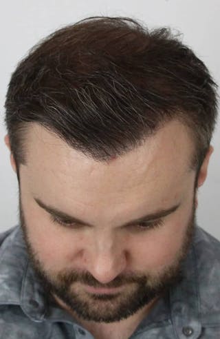 Results Before & After Gallery - Patient 423185 - Image 6