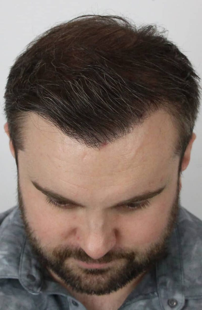 Results Before & After Gallery - Patient 423185 - Image 6