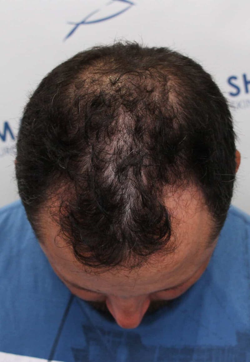 Results Before & After Gallery - Patient 208284 - Image 1