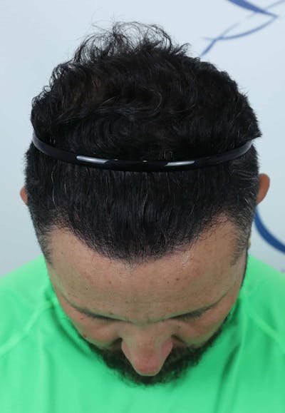 Results Before & After Gallery - Patient 208284 - Image 2