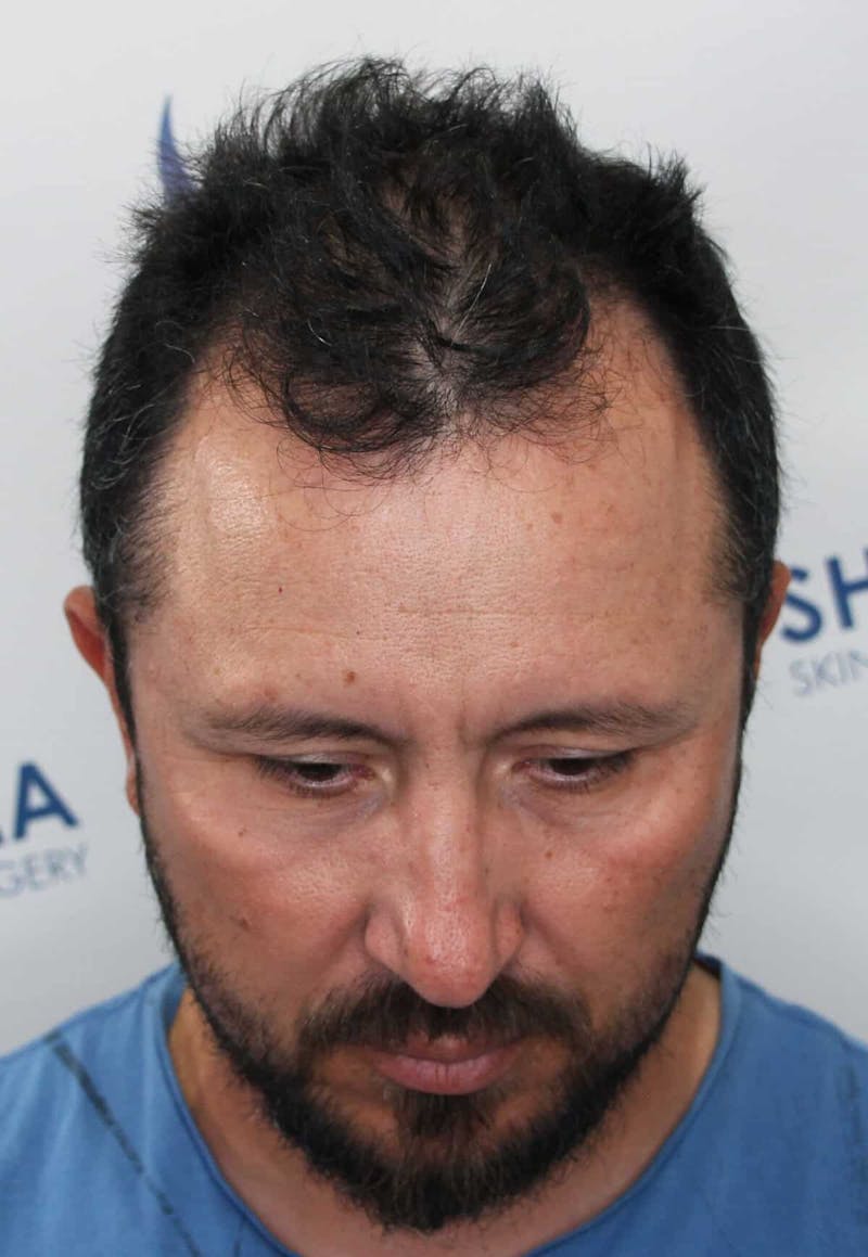 Results Before & After Gallery - Patient 208284 - Image 3