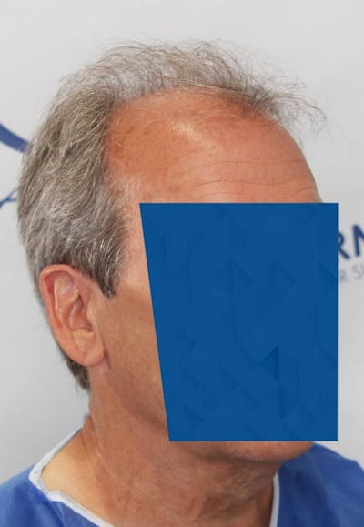 Results Before & After Gallery - Patient 339158 - Image 1